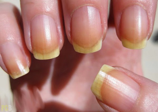 1-discolored-nails